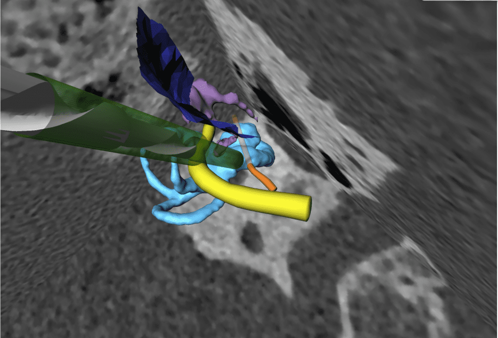 RCI Trajectory for entry into the cochlea at the preplanned angle. Yellow: Facial Nerve, Orange: Chorda Tympani, Light Blue: Cochlea, Dark Blue: Posterior Wall of the External Auditory Canal, Purple: Ossicles, Green: Planned Trajectory, Grey: Robot Drill Bit. © ARTORG Center for Biomedical Engineering Research, University of Bern.