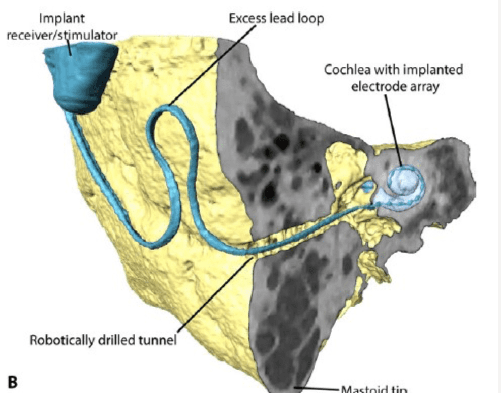 RCI drill trajectory across the mastoid bone. © ARTORG Center for Biomedical Engineering Research, University of Bern.