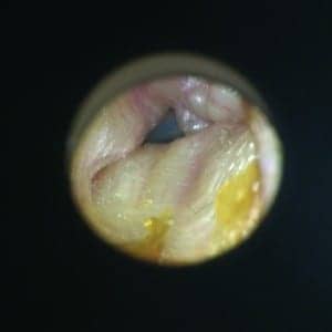 Left and right otoscopy of ear canals with large external auditory canal exostoses. The cartilaginous portions of the ear canals were typical and clear of obstruction up to the bony portion of the canal. The patient has a history of successfully wearing receiver-in-canal (RIC) hearing aids with non-custom silicone tips.