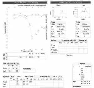 Figure 1. Initial audiogram for 51-year-old patient who experienced sudden hearing loss in his right ear, and initially thought it was due to surfer’s ear. However, an MRI revealed a possible acoustic neuroma.