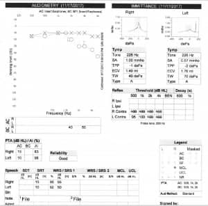 Figure 2. After treatment with oral prednisone and three intratympanic injections, the patient experienced a 35-70 dB improvement in the right ear.