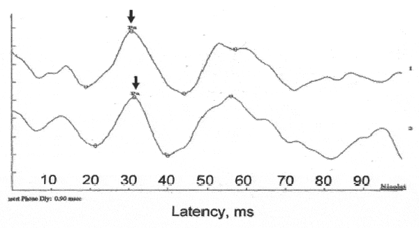 Effect of Contralateral Noise on the Click-evoked Human Auditory Middle ...