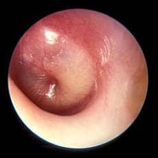 Otitis MediaWiki