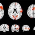 Neurofeedback May Reduce Severity of Tinnitus, Study Shows