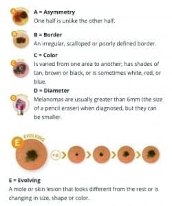 Figure 1. ABCDEs of skin cancer screening. Printed with permission from the American Academy of Dermatology.11