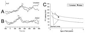 Figures 1a-c. P1 CAEP waveforms (with replications) for an ANSD child in prior to hearing aid use (Panel A) and several months after bilateral hearing aid use (Panel B). Averaged P1 CAEP latencies in the unaided and aided conditions are plotted against 95% confidence intervals for normal P1 latency9 (Panel C). Results indicate delayed P1 latency prior to hearing aid use. Within several months of hearing aid use, P1 latency was age-appropriate. Adapted from Cardon et al (2012).36