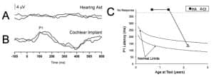 Figures 2a-c. P1 CAEP waveforms (with replications) for an ANSD child during bilateral hearing aid use (Panel A) and several months after cochlear implantation of the left ear (Panel B). Averaged P1 CAEP latencies hearing aid and cochlear implant conditions are plotted against 95% confidence intervals for normal P1 latency9 (Panel C). Results indicate absent P1 responses during hearing aid use. Within several months after left-ear cochlear implantation, P1 latency was age-appropriate. Adapted from Cardon at al (2012).36