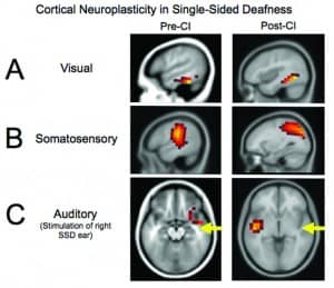 Figures 3a-c. Cortical visual, somatosensory, and auditory neuroplasticity in a pediatric case of single-sided deafness before and after cochlear implantation. Before cochlear implantation, the auditory cortex is recruited for visual processing (Panel A) and somatosensory processing (Panel B), suggestive of cross-modal reorganization. Post-implantation, complete or partial reduction in auditory cortex recruitment for visual and somatosensory processing is observed. Before cochlear implantation, auditory stimulation results in abnormal (eg, ipsilateral) activation of the auditory cortex (Panel C), as well as the additional recruitment of frontal and prefrontal cortex—indicative of effortful listening. Post-implantation, a restoration of more typical (eg, contralateral) auditory cortical activation and reduction in frontal activation is observed. Adapted from Sharma et al (2016).43