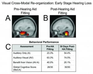 Figures 4a-c. Cross-modal recruitment by vision in mild-moderate bilateral sensorineural hearing loss before and several weeks after hearing-aid fitting. Panel A: Pre-hearing aid fitting, the adult shows recruitment of temporal (auditory) cortex for visual processing in addition to occipital (visual) cortical areas, suggestive of cross-modal reorganization by vision. Panel B: Within several weeks of hearing aid use, we see a reversal of cross-modal recruitment and expected activation of cerebellar/occipital areas to a visual motion stimulus. Panel C: Behavioral performance on an auditory/visual speech perception in noise test (AzAV) delivered as auditory-only and auditory-visual conditions, and a global cognitive function assessment (MoCA) administered pre-hearing aid fitting and post-hearing aid fitting. Within several weeks of hearing-aid fitting, this adult showed increased auditory-only performance in background noise, decreased functional reliance on visual cues for speech perception, and increased global cognitive function.