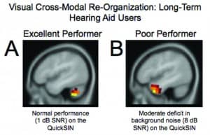 Figures 5a-b. Panel A: In response to the visual motion stimulus, the hearing aid user with excellent speech perception (1 dB SNR on the QuickSIN) shows activation restricted to occipital/cerebellar (visual) regions. Panel B: The hearing aid user with poor speech perception in noise (8 dB SNR on QuickSIN) shows activation in temporal (auditory) cortical regions, suggestive of cross-modal reorganization by vision. Adapted from Glick & Sharma (2017).39