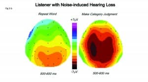 Figure 3a-b. Comparison of waveforms and AERP scalp topographies for simple word repetition versus category judgment in a 41-year-old listener with mild sensorineural hearing loss. Top Panel: Comparison of topographic brain maps computed over the 500-600 msec latency range. Note larger area of maximal brain activity over the left hemisphere and greater extension into the right hemisphere in the case of category judgments. Bottom panel: Audiogram and waveforms at electrode C3.