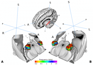 Visualization of the medial geniculate body (MGB) in the brain of human test persons. The MGB is part of the auditory pathway. It is organized in such a way that certain sections represent certain sound frequencies. The study shows that the part of the MGB that transmits information from the ear to the cerebral cortex is actively involved in human speech recognition.